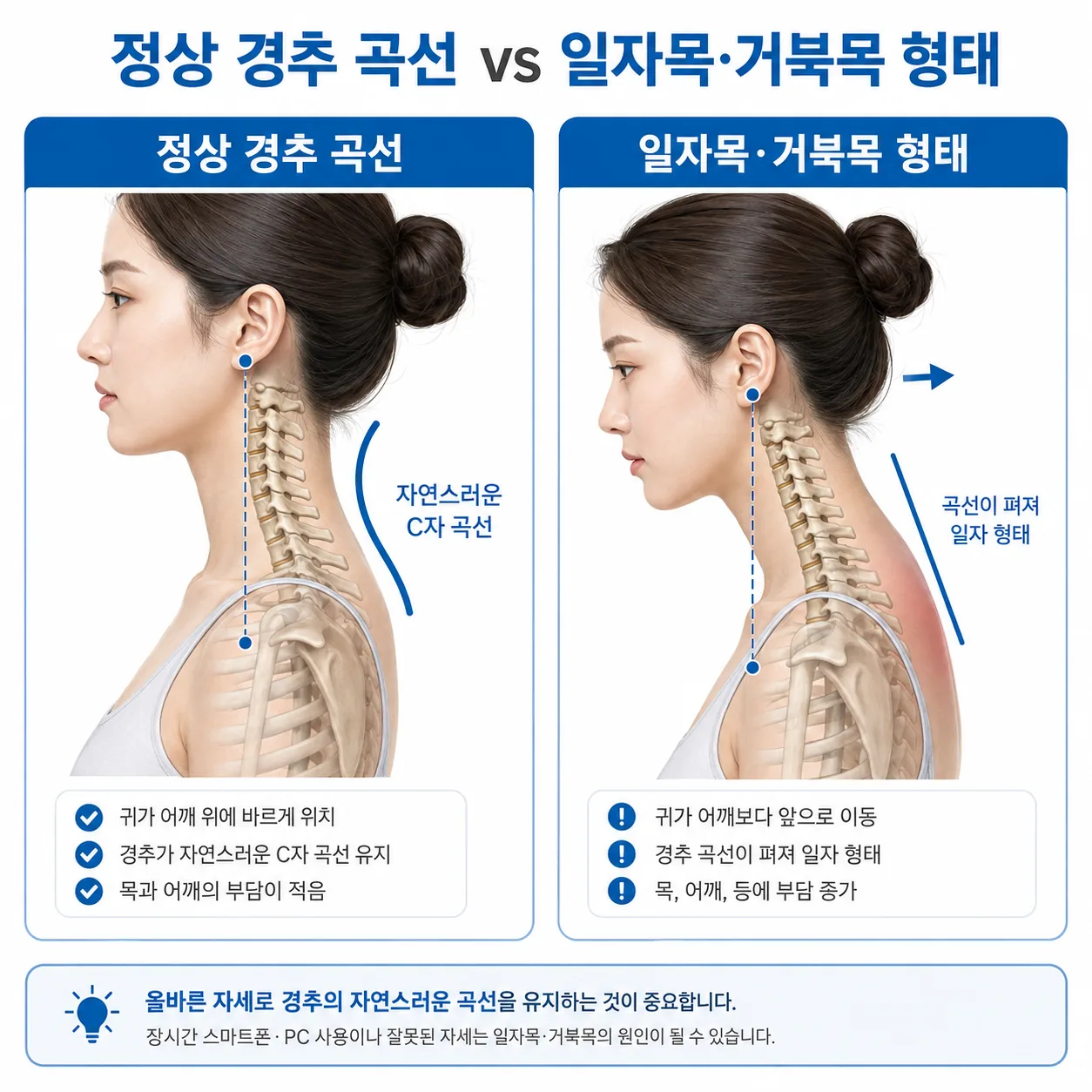 정상 C자 경추 곡선과 일자목 거북목 형태 비교