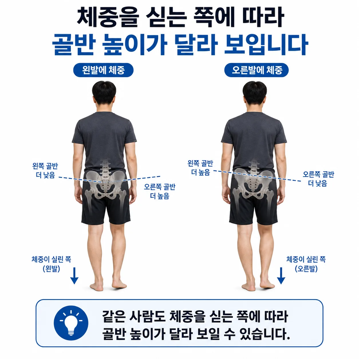 체중을 싣는 쪽에 따라 골반 높이가 달라 보이는 것을 비교한 도해