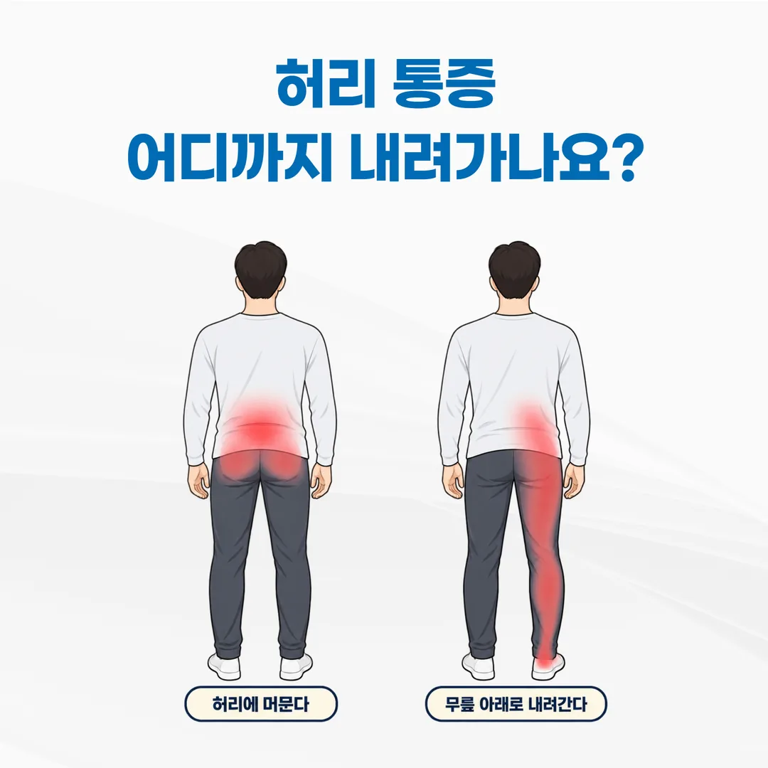 요추 염좌와 요추 추간판탈출증의 통증 분포 비교 개념도