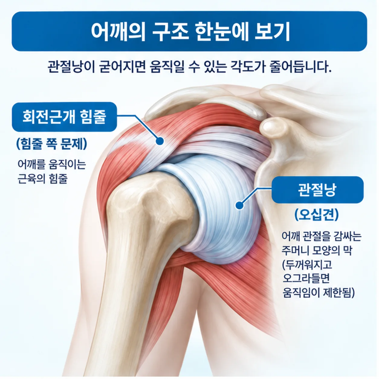 어깨 관절낭과 회전근개 힘줄의 위치를 비교한 도해