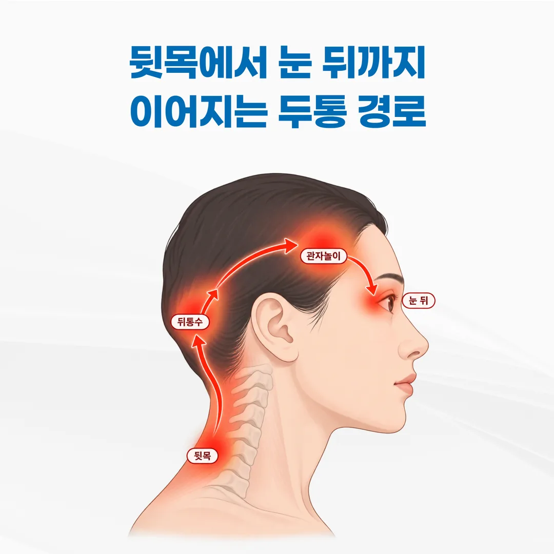 뒷목에서 한쪽 관자놀이로 통증이 번지는 경추성 두통의 통증 경로 개념도